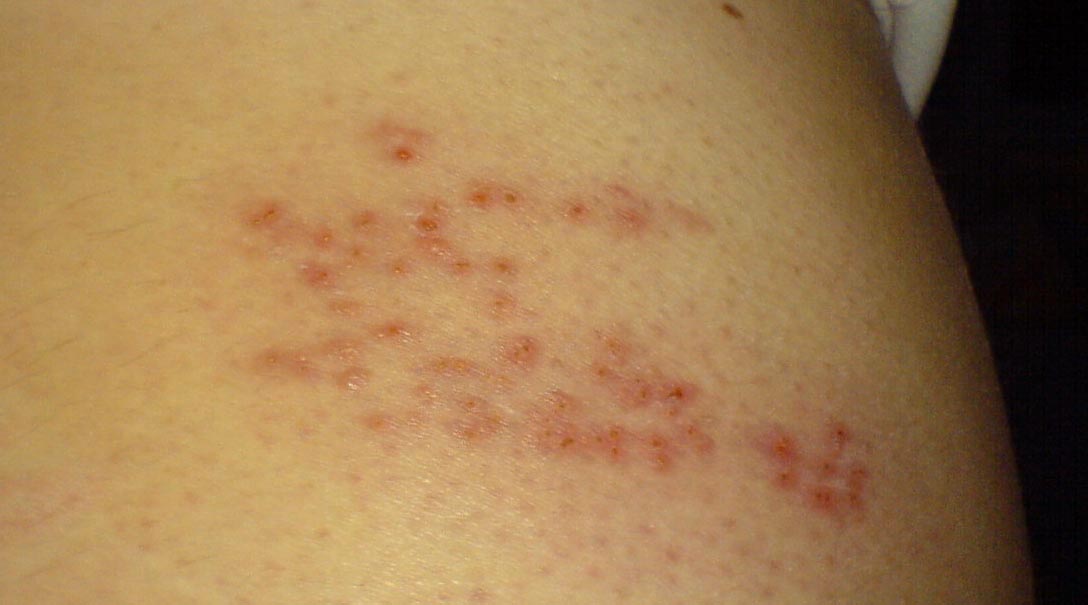 Shingles virus traduction